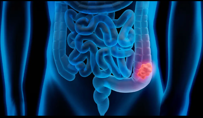 Illustration accompanying a preclinical study of saffron compounds and colorectal cancer signalling
